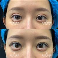 长沙周杰医生眼综合整形