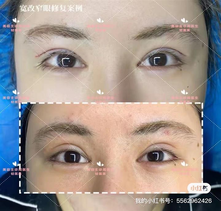 长沙周杰整形医生眼综合