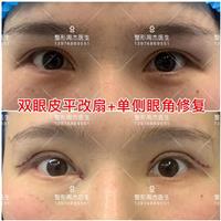 长沙周杰医生双眼皮修复