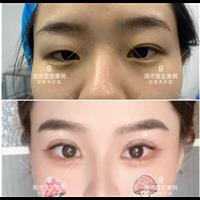 长沙周杰医生双眼皮整形