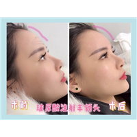 重庆鼻综合整形|重庆做线雕隆鼻