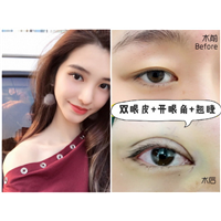 重庆玻尿酸注射隆鼻|重庆注射玻尿酸哪家好