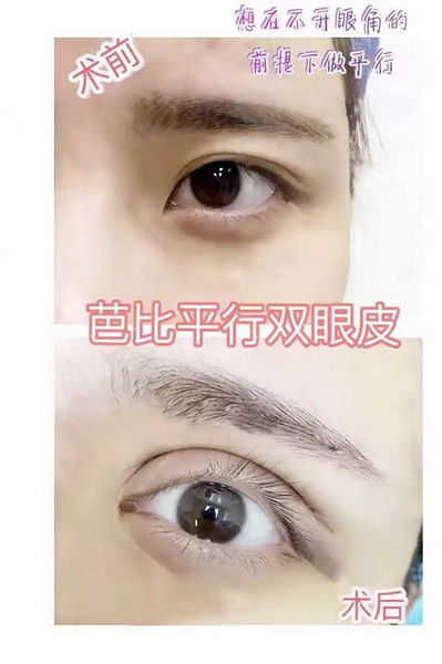 重庆注射玻尿酸|重庆玻尿酸注射隆鼻