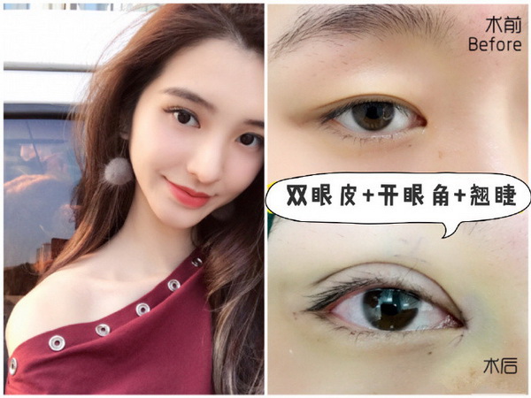重庆玻尿酸注射隆鼻|重庆注射玻尿酸哪家好