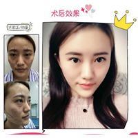重庆做线雕隆鼻|重庆做鼻综合哪家好