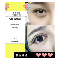 重庆做眼综合哪家好|重庆注射玻尿酸