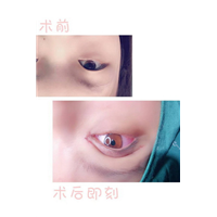 重庆眼综合整形|重庆做眼综合哪家好