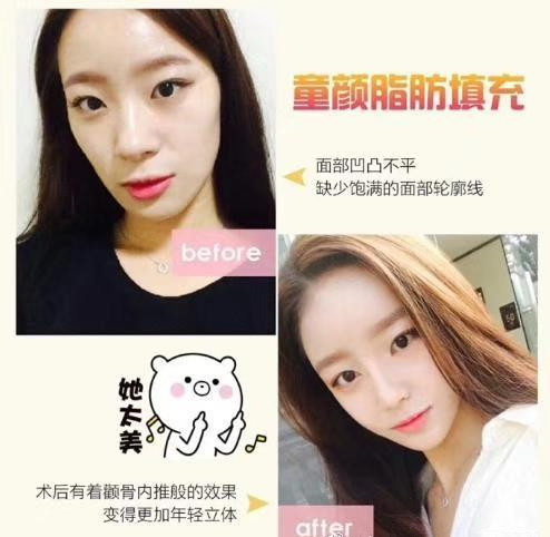 重庆鼻综合整形|重庆做线雕隆鼻