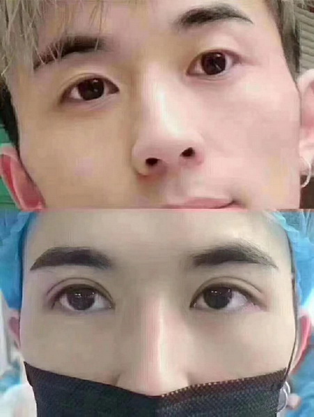 重庆做眼综合哪家好|重庆注射玻尿酸