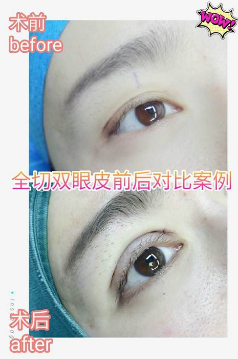 广东网红整形医院|广东鼻综合整形