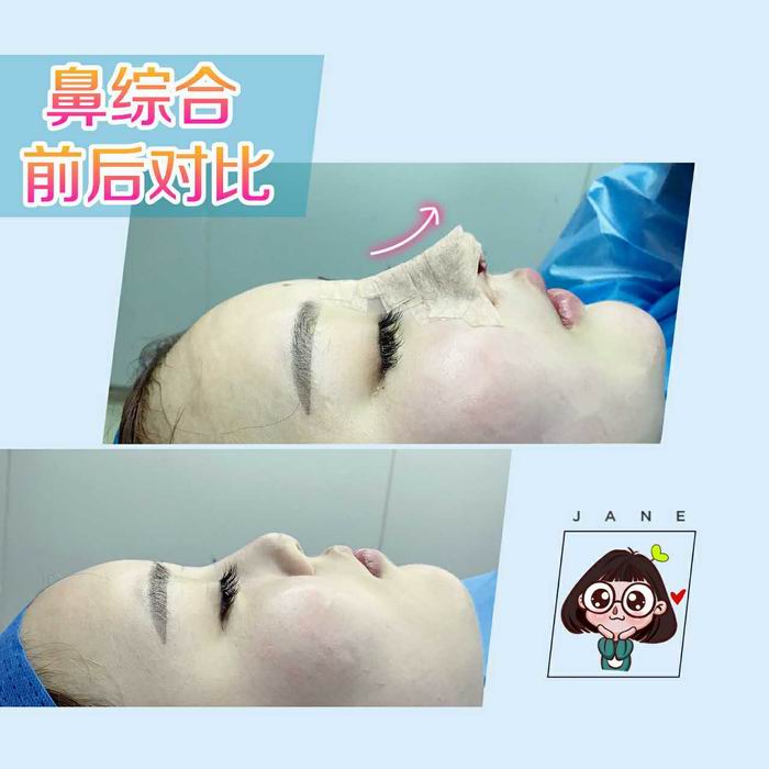 广东网红整形医院|广东鼻综合整形