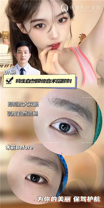 轻雅医疗美容妈生自然眼综合术后