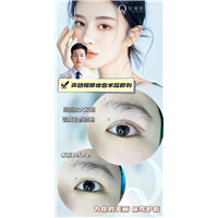 广州眼修复宽改窄术后即刻