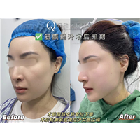 轻雅医疗美容筋膜提升术后即刻