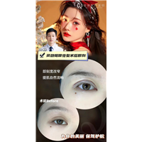 广州轻雅整形灵动媚眼修复术后即刻
