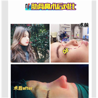 上海耳软骨隆鼻整形好不好