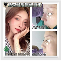 做假体隆鼻需要多长时间?全过程解析
