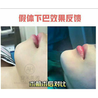通常下巴整形需要多少钱呢