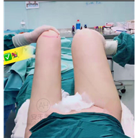 吸脂整形手术要花多少钱?手术费用解析