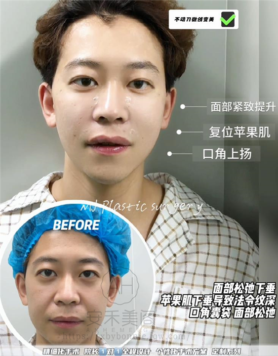 做意大利筋膜悬吊术效果怎么样