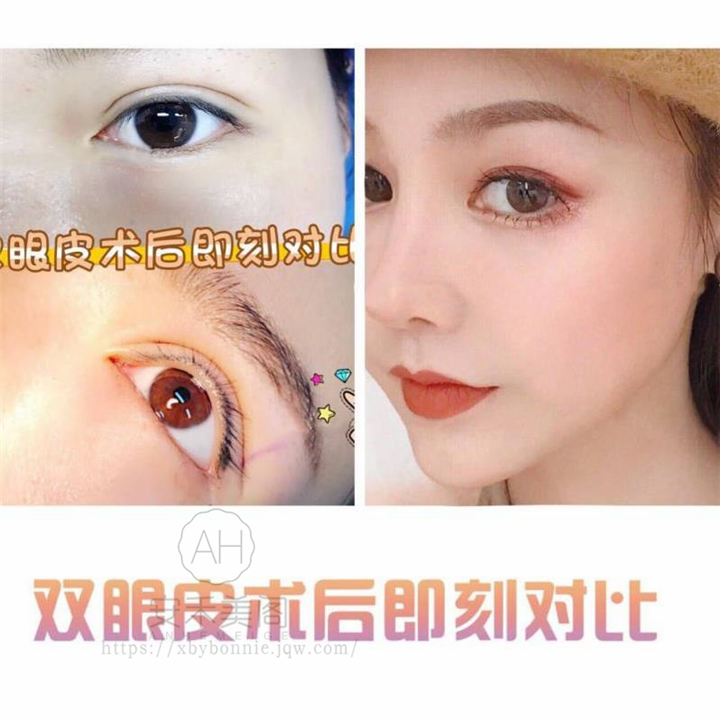 割双眼皮整形需要多长时间恢复