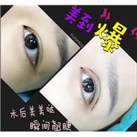 哪种双眼皮手术效果好,做哪种手术双眼皮好