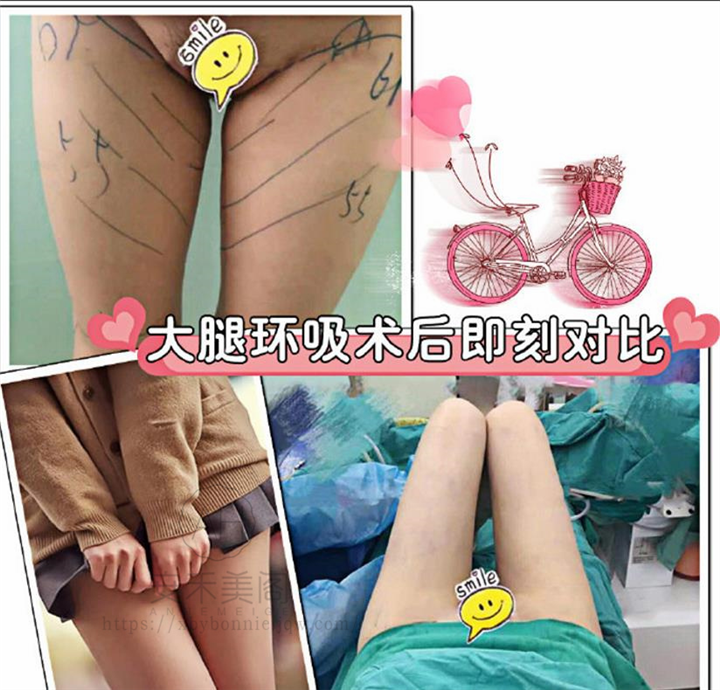 上海吸脂瘦身哪个好