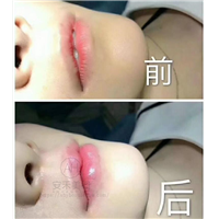 垫下巴整形的变美方法有几种