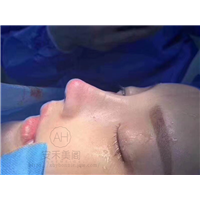 上海肋软骨鼻综合整形哪家好