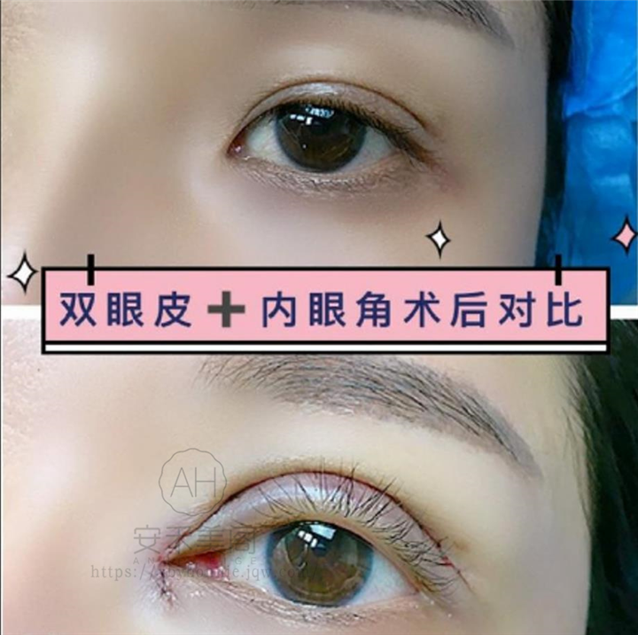 微创双眼皮整形手术的优势有哪些