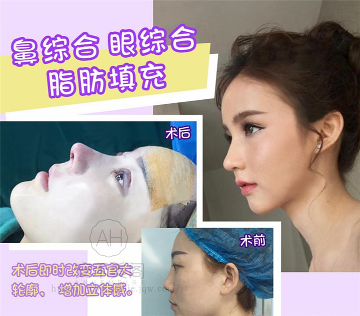 上海做鼻综合哪家好科普一下