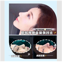 做耳软骨垫鼻尖需要多长时间?