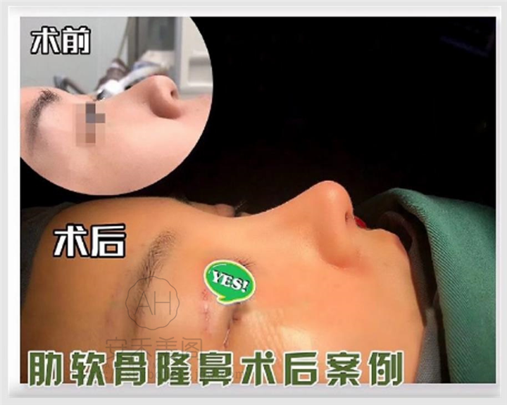 做短鼻矫正需要多长时间?全过程解析