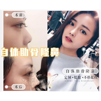 自体软骨隆鼻手术的恢复期需要多久呢