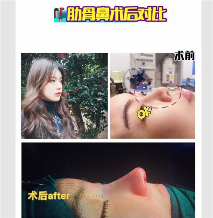 做鼻中隔软骨垫鼻尖的步骤及注意事项