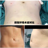 腹部吸脂常见的方式是什么?腹部吸脂价格怎么样