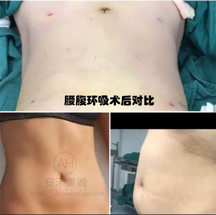 腹部吸脂常见的方式是什么?腹部吸脂价格怎么样