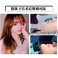 垫下巴的好处是什么？能改善脸型吗