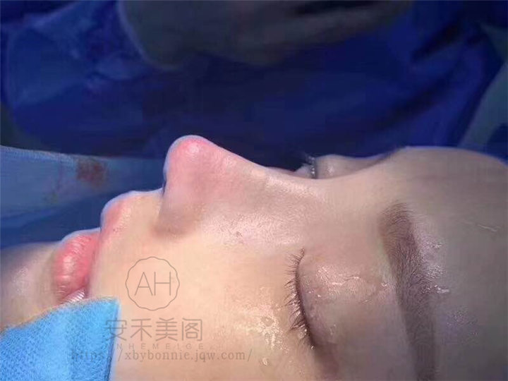 上海肋软骨鼻综合整形哪家好