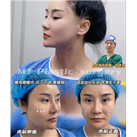 做筋膜悬吊术抗衰恢复期多久