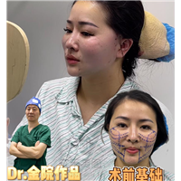 筋膜悬吊术和线雕哪个好