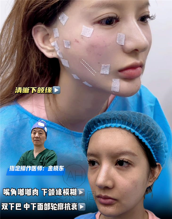 意大利SMAS筋膜悬吊术