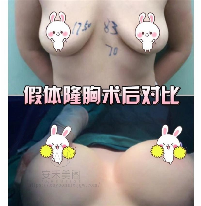 自体脂肪丰胸和假体丰胸哪个好