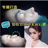 上海隆鼻哪家好