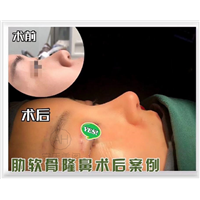做短鼻矫正需要多长时间?全过程解析