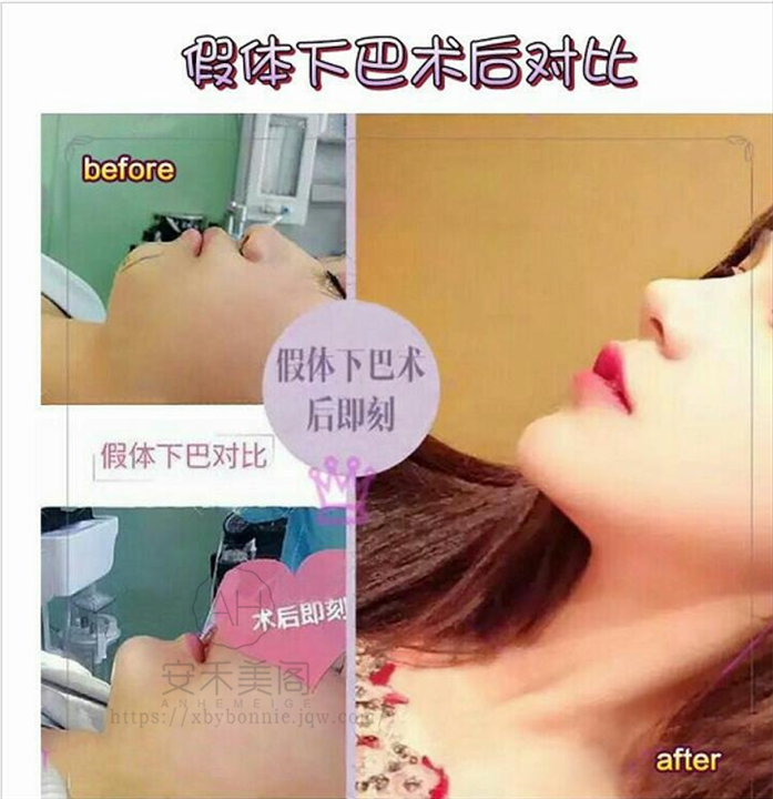 影响垫下巴整形价格的因素有哪些