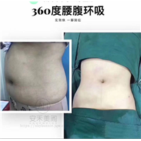 吸脂整形是吸哪个地方?一次能吸多少