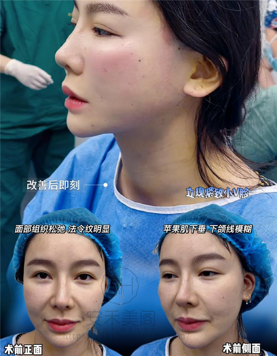 筋膜悬吊提升术是什么