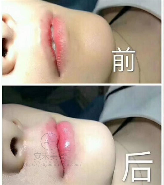 垫下巴整形的变美方法有几种