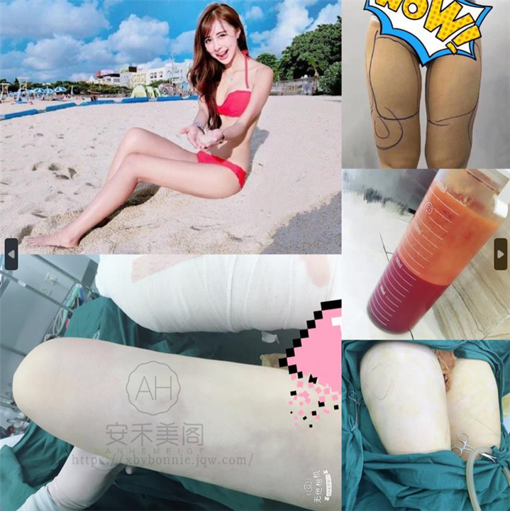 吸脂整形减肥好吗?吸脂会伤害身体吗